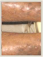 After Treatment