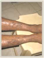After Treatment