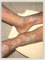 Before Treatment
